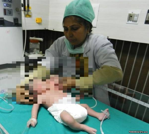 В Индии родился ребенок с двумя головами (4 фото)