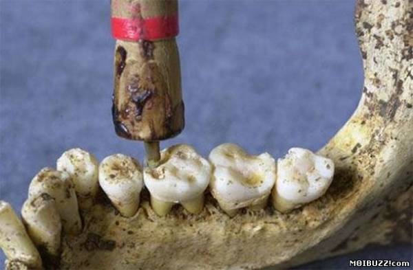 Зубная пломба, которой 2000 лет (фото)